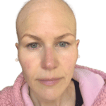 Chemo Hair Loss