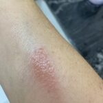 Chemo Skin Issues