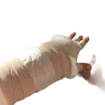 Arm Wrapping to decrease Swelling from Lymphedema